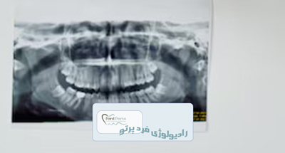 رادیوگرافی پری اپیکال