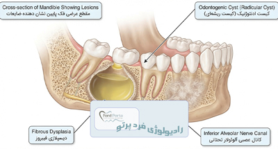کیست و ضایعات فکی چیست؟ علائم و نقش رادیوگرافی و CBCT | فردپرتو تهران